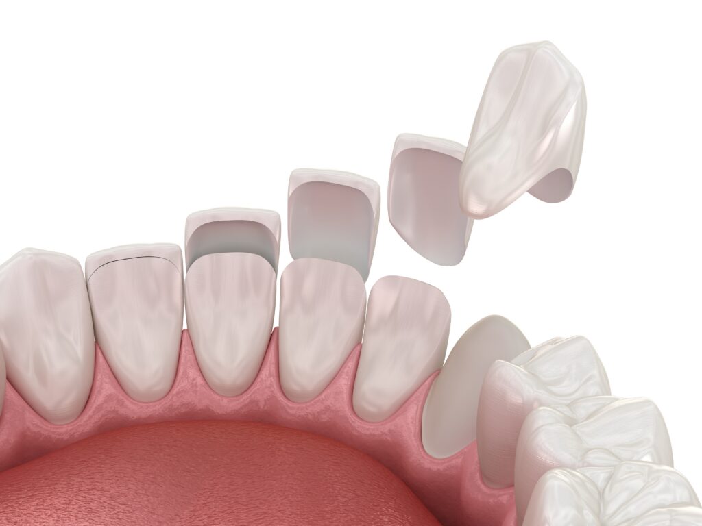 Graphic of veneers being place on lower anterior teeth