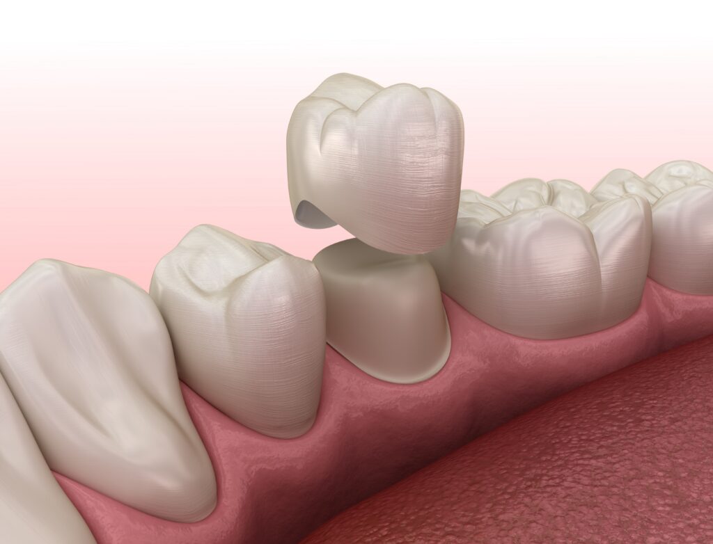 3D rendering of a dental crown being placed on a tooth