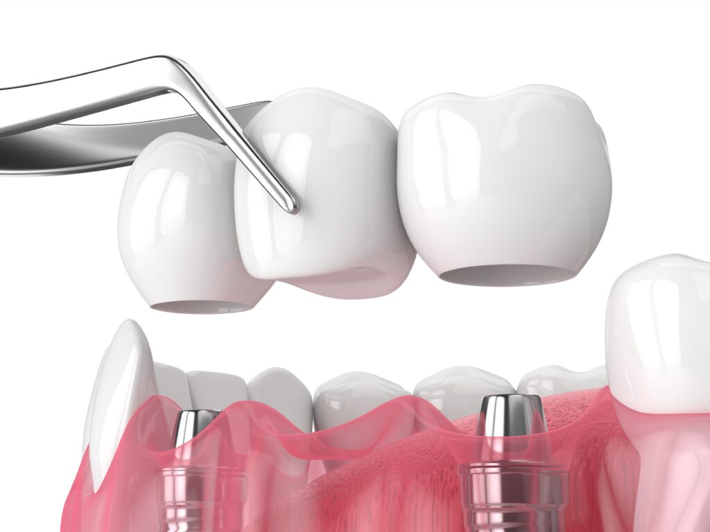 3D rendering of an implant supported bridge.