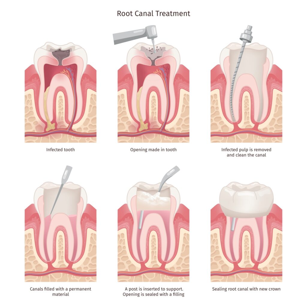 A graphic chart showing the steps of root canal treatment