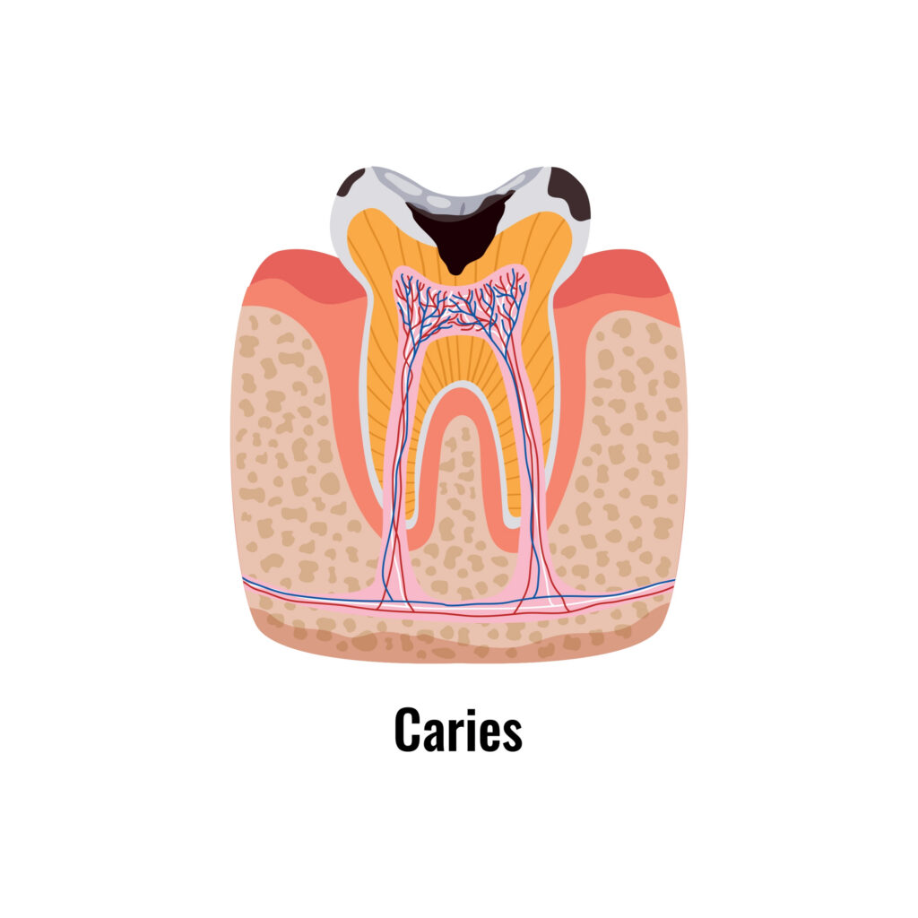 Diagram of a tooth with a cavity
