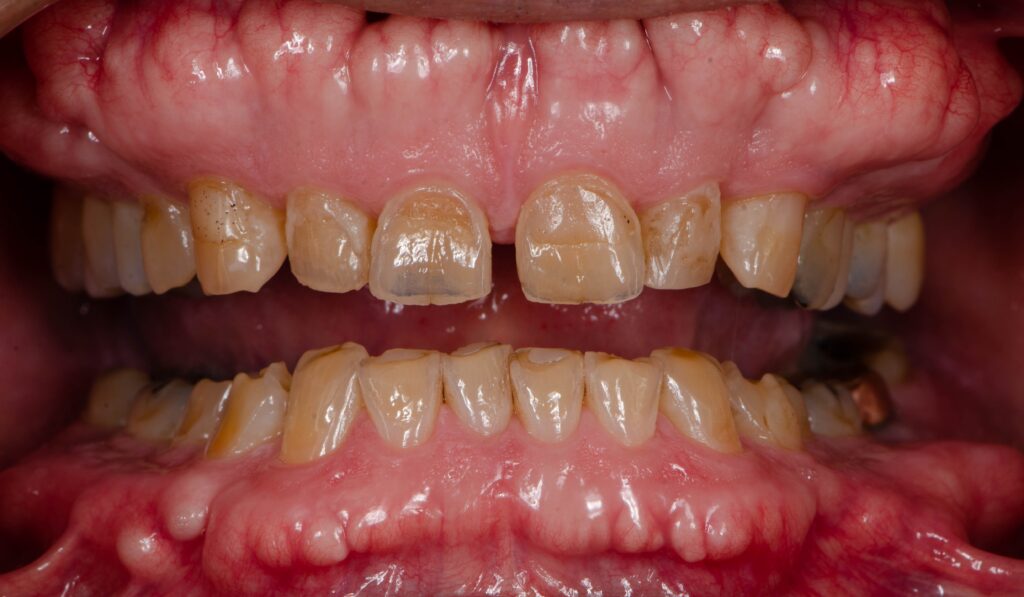 Photo showing close up of teeth with dental erosion