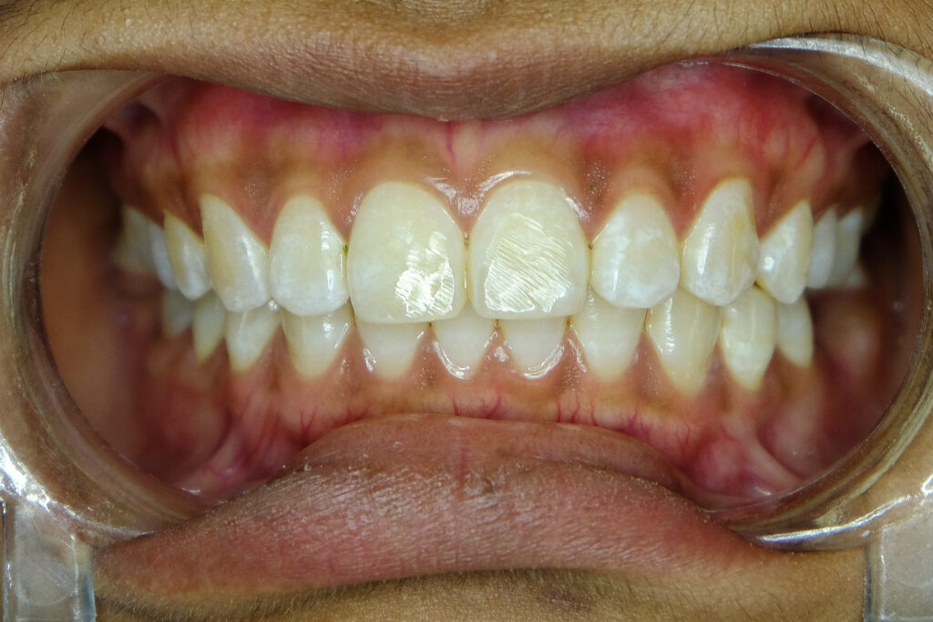Close up photo of teeth with mild fluorosis