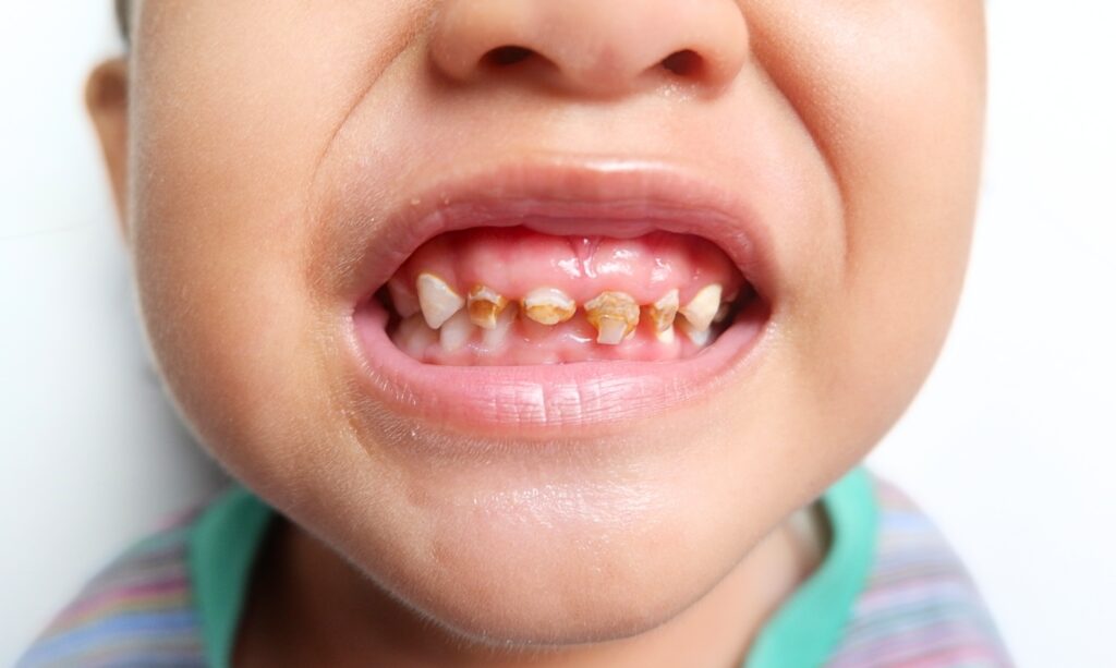 Close up photo of teeth with hypoplasia