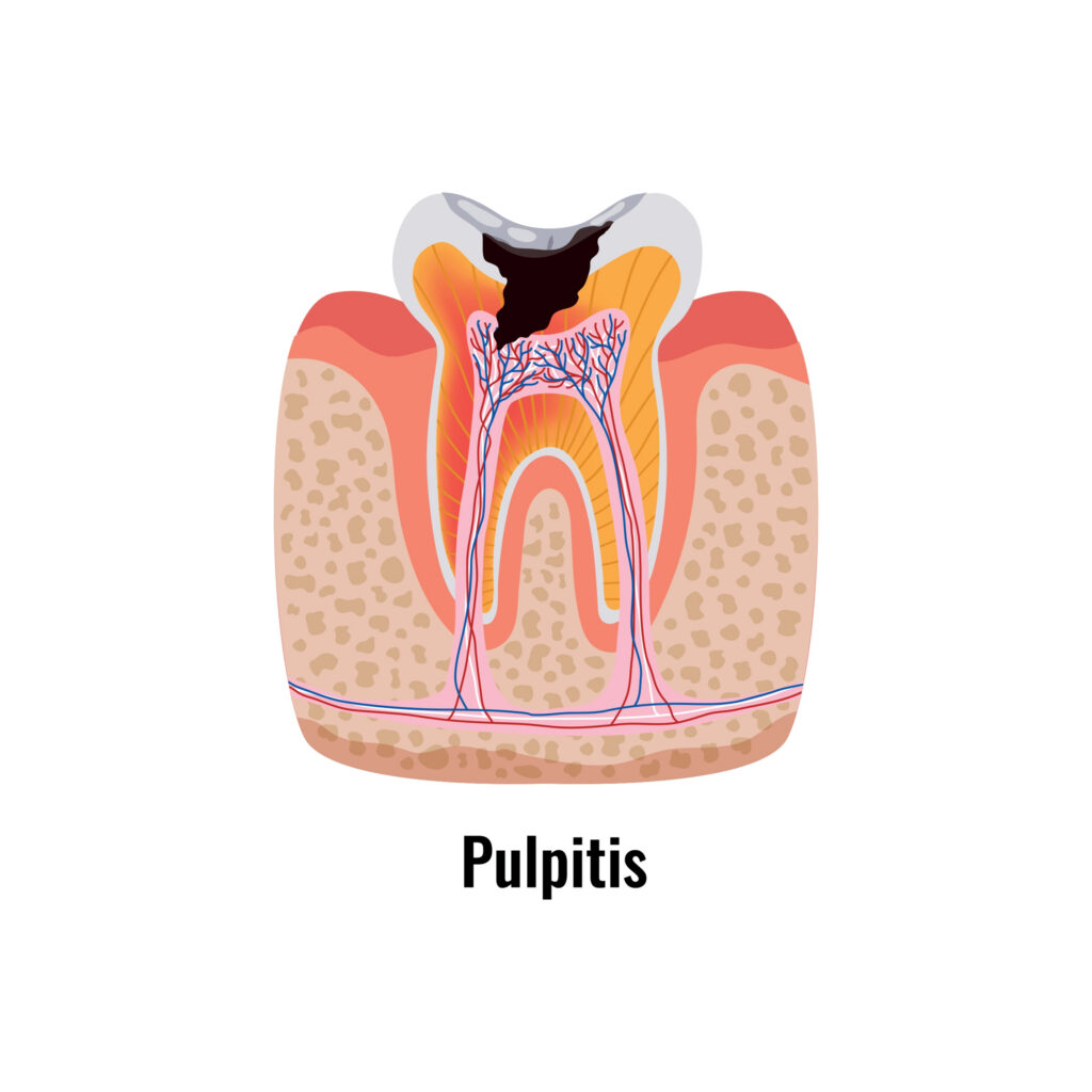 Diagram of a tooth with pulpitis.