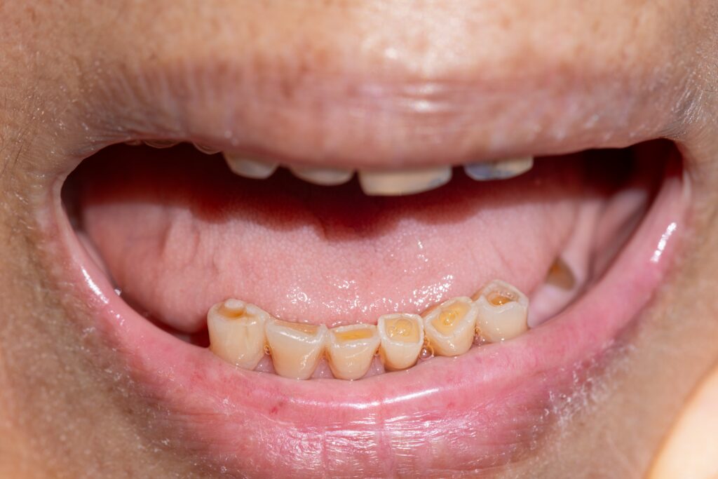 Close up photo of lower anterior teeth with attrition (severe tooth wear)