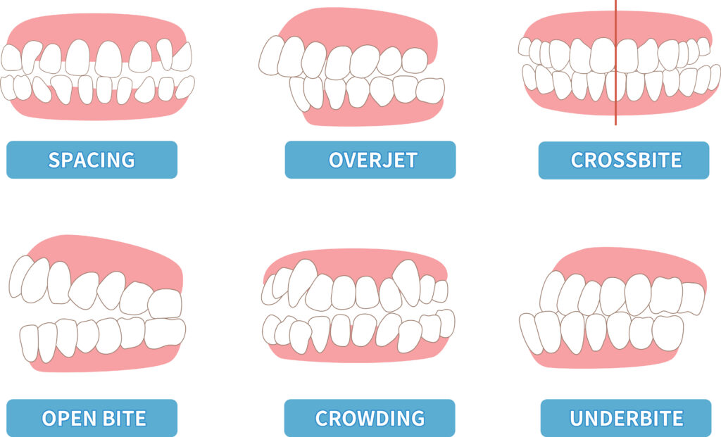 Diagram of six sets of teeth each showing a different malocclusion issue.