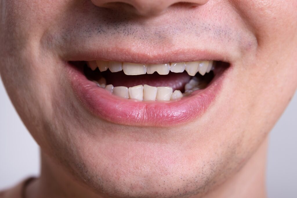 Close up photo of a male smiling with a chipped front tooth.