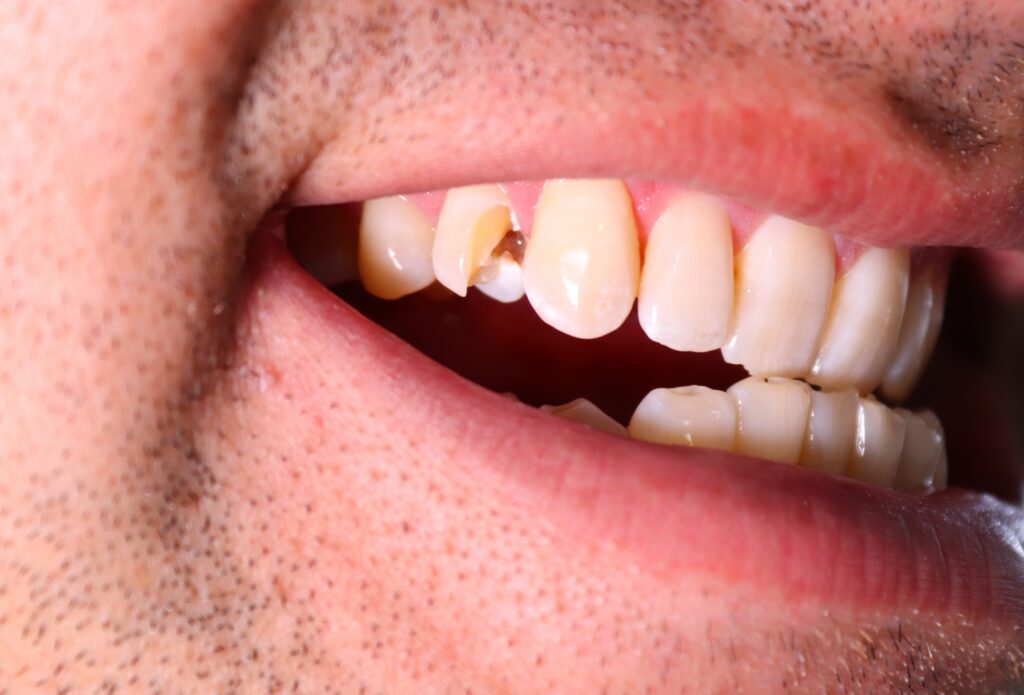 Close up photo of a male with a broken tooth.