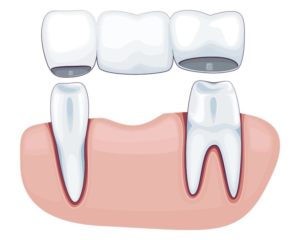 3D rendering of a dental bridge that is off of the teeth.