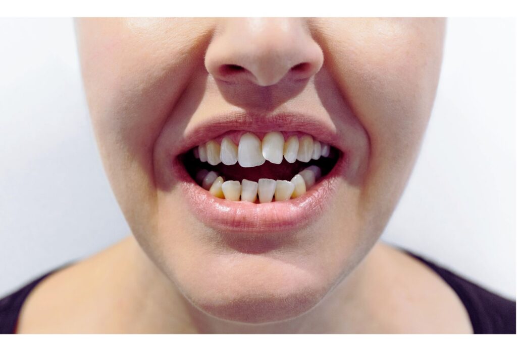 Close up photo of a woman's teeth that are crooked.