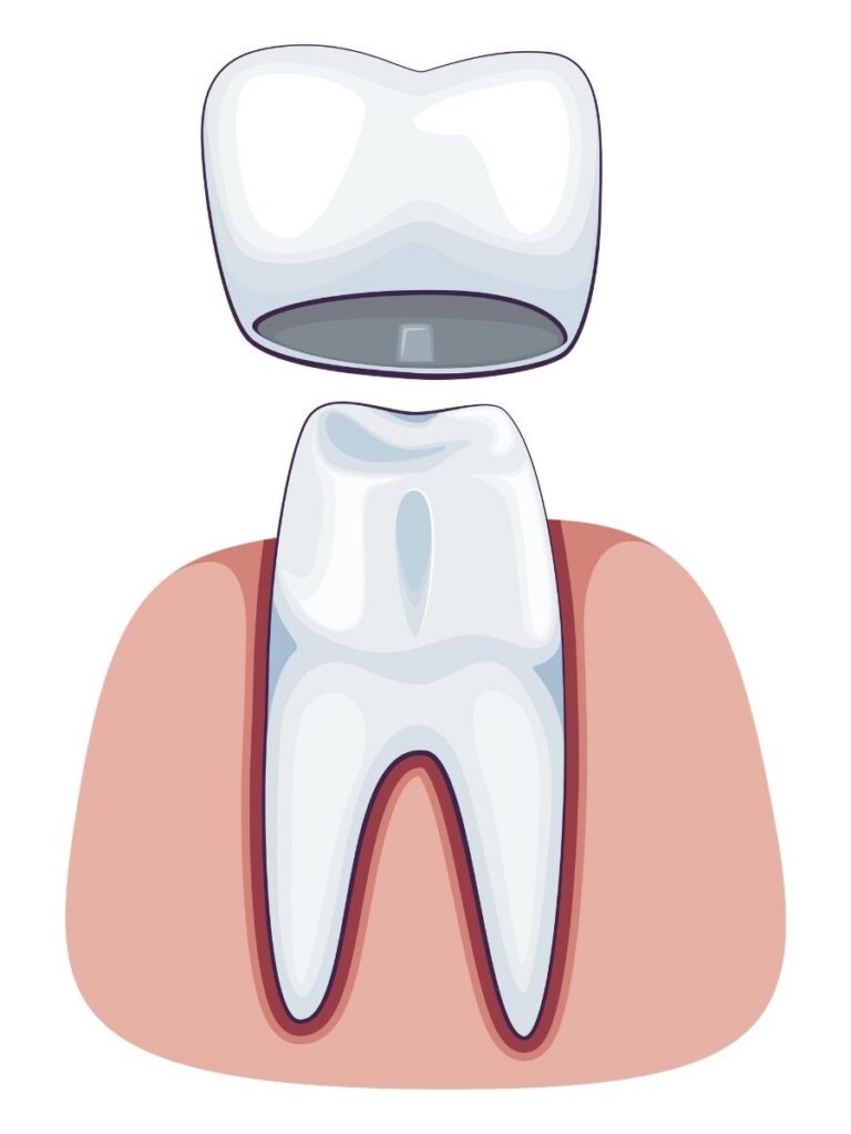 3D rendering of a dental crown that is off the tooth.