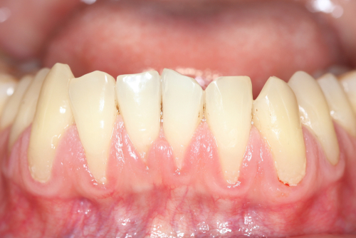 Close up photo of lower anterior teeth with gum recession