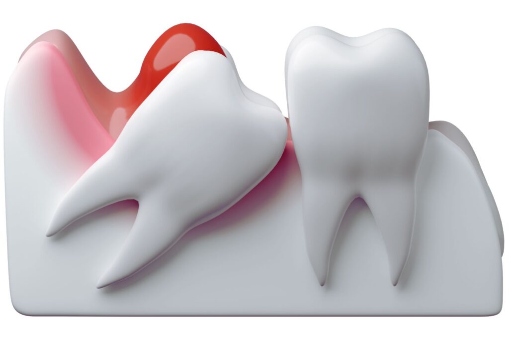 3D Rendering of an impacted wisdom tooth.