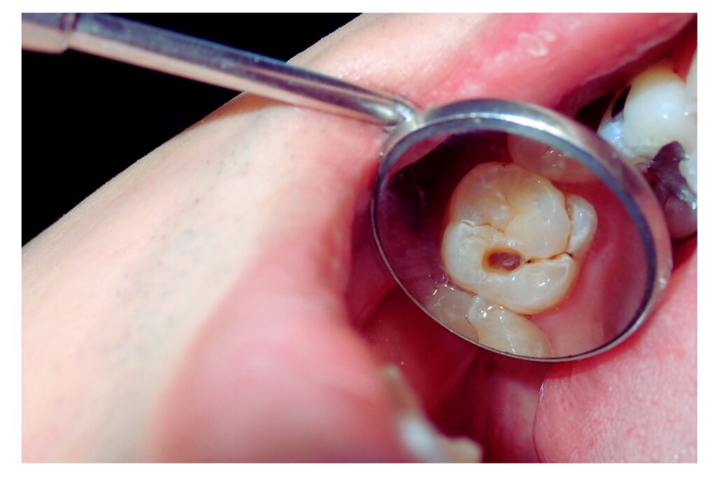 Close up photo of a tooth that has a hole from where a filling fell out of it.
