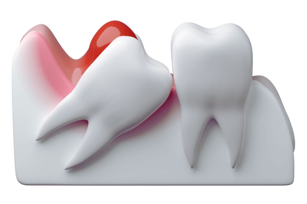 3D rendering of a partially impacted wisdom tooth with pericoronitis.