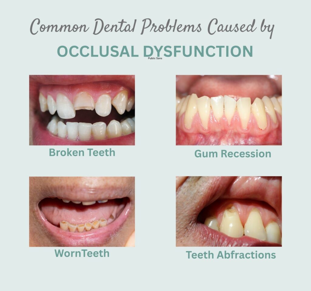 Graphic with photos of common dental problems caused by occlusal dysfunction.