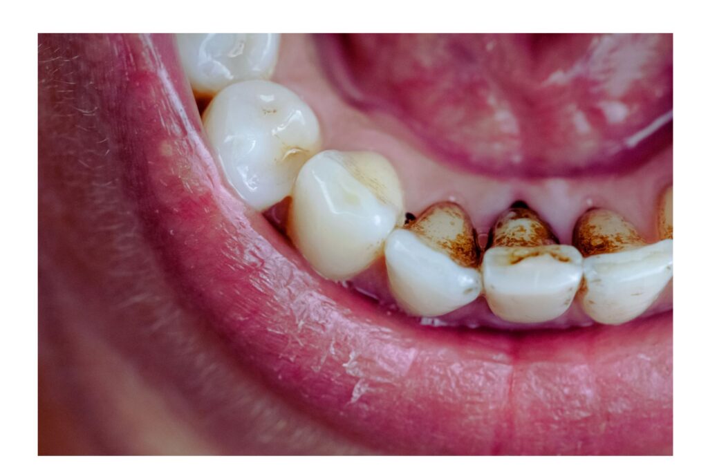 Close up photo of stained teeth.