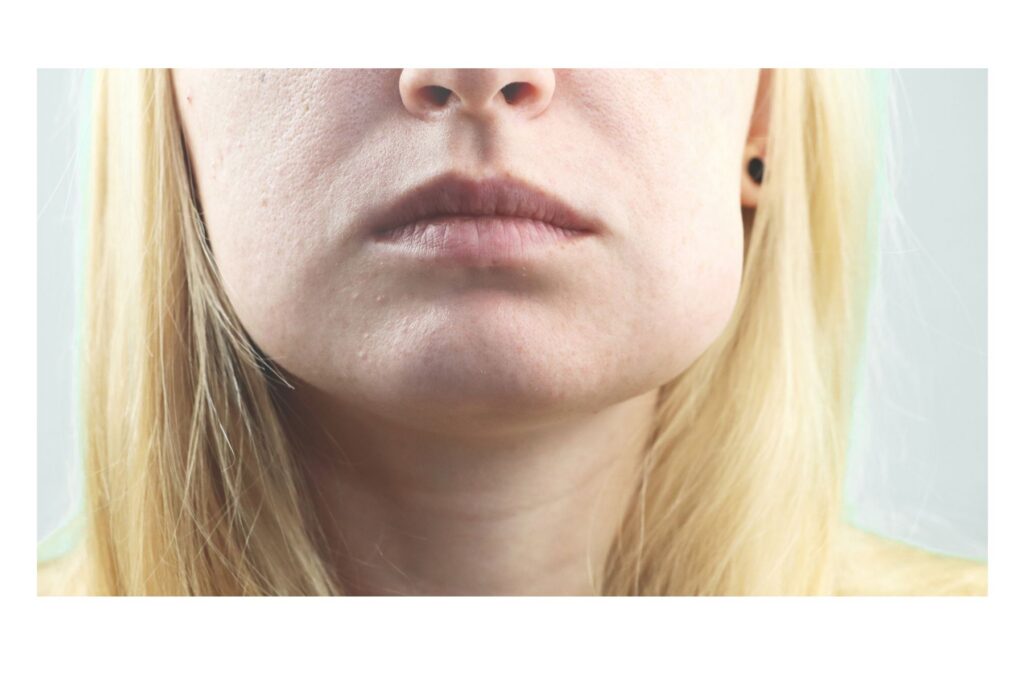 Close up photo of a woman with a swollen jaw from a tooth infection.