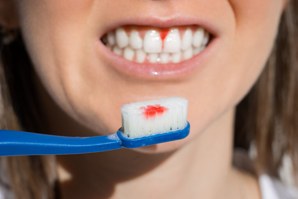 Close up photo of a woman holding up a toothbrush to her mouth with blood on the toothbrush and her gums