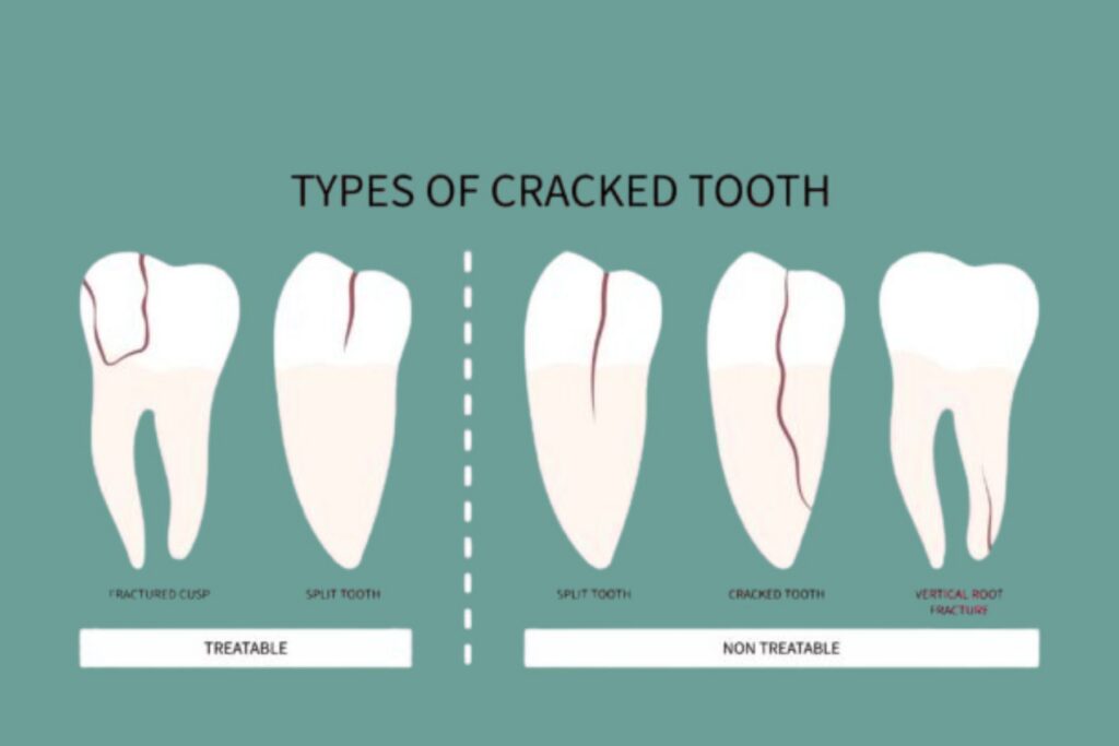 Diagram of 5 teeth showing the 5 different types of cracks that can form on teeth