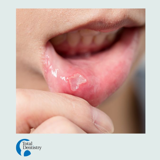 Close up picture of a mouth sore on the inside of a person's lower lip.